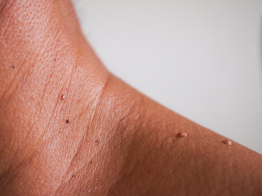 Close-up the skin tags on neck man skin.