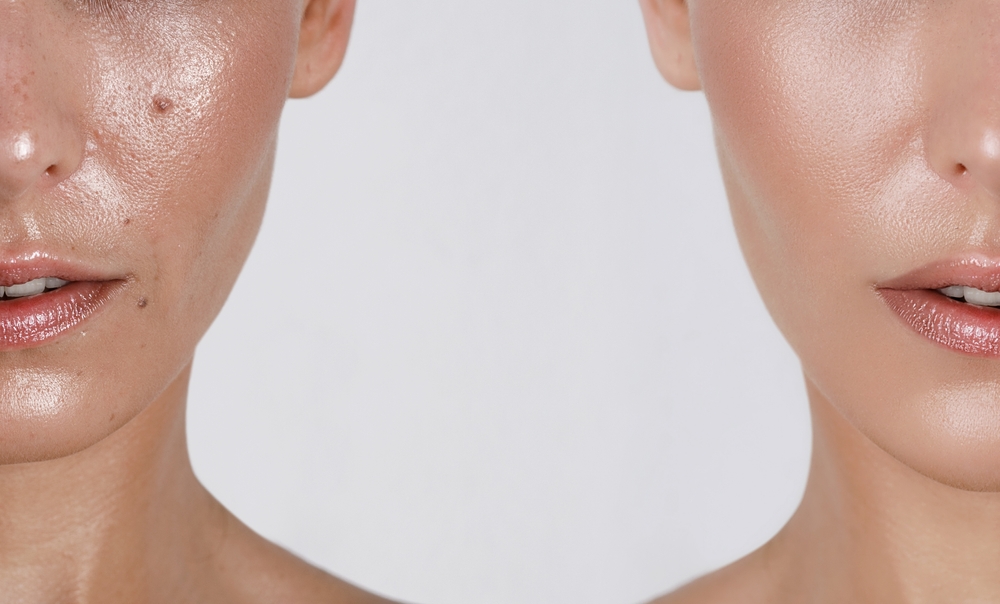 close-up girl with hyperhidrosis on her face and excessive oily sheen, with enlarged pores and nevus. before and after treatment with botulinum toxin injections