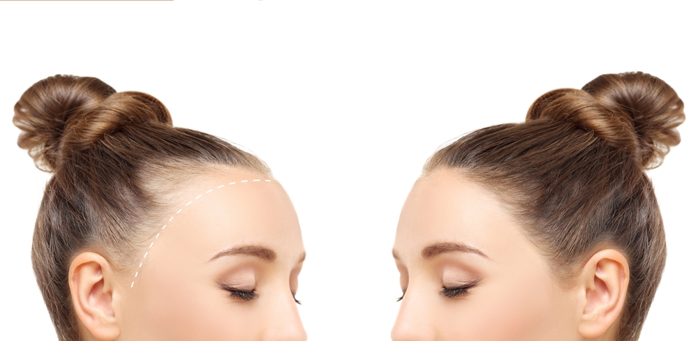 Thinning hair and hair loss,female pattern baldness,Hair transplant