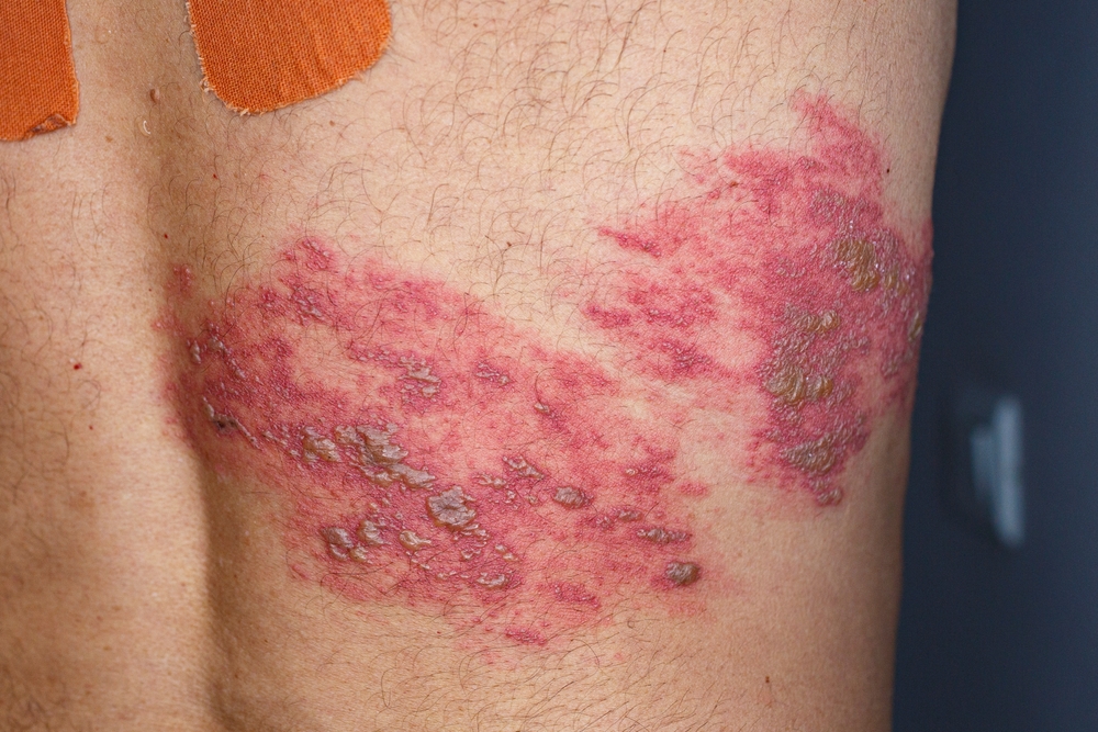 Skin lesion symptom in Shingles or Herpes zoster in human. Shingles or Herpes zoster is aviral disease caused by varicella zoster virus charatrized by a painful skin rash with blisters on the body.