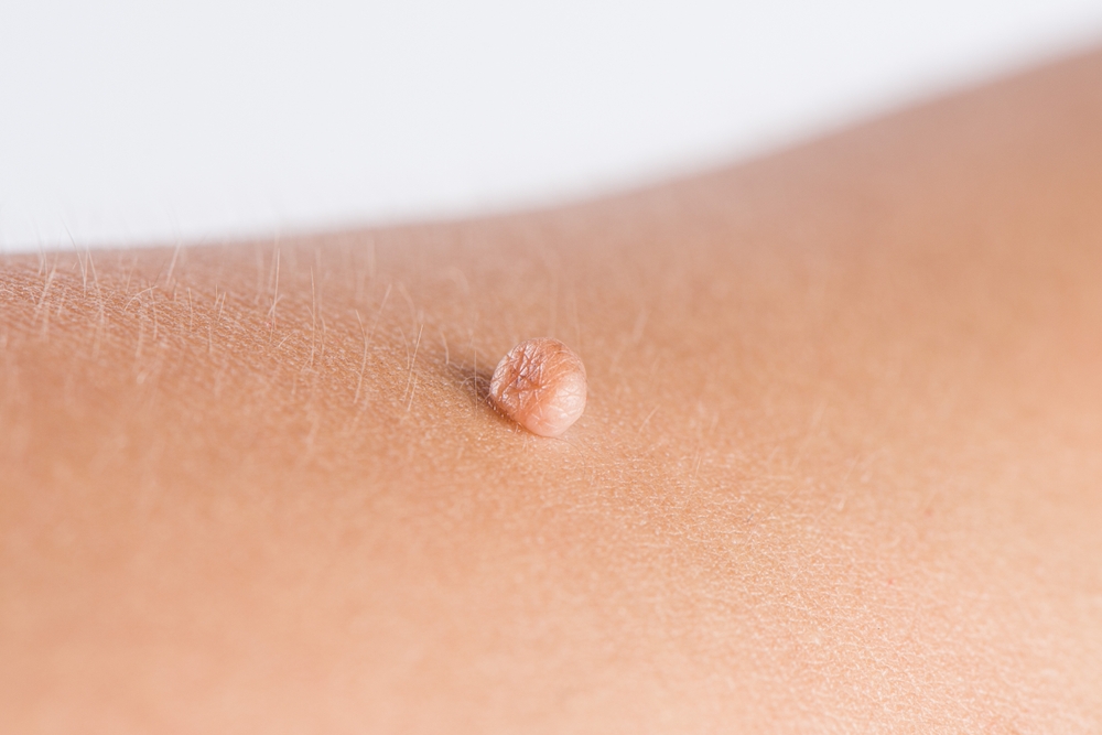 Skin tag or acrochordon or soft fibrom dermatology problem on skin concept.