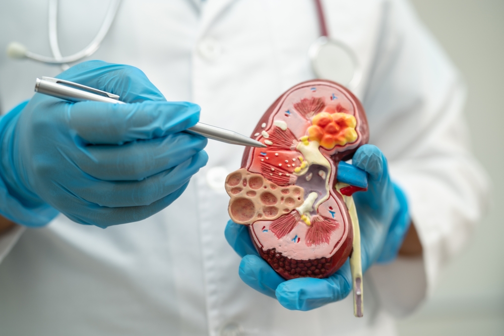 Kidney disease, Chronic kidney disease ckd, Doctor hold model to study and treat in hospital.