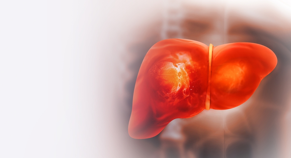 Liver damage such as Fatty liver, Fibrosis, Cirrhosis, and Liver cancer. 3d illustration