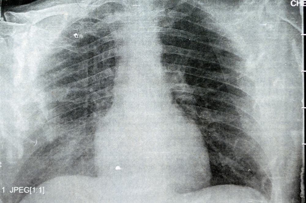 Plain x ray chest showing infectious pulmonary process pneumonia with right side minimal para-pneumonic effusion, right sided aspiration pneumonia that could be complicated to empyema