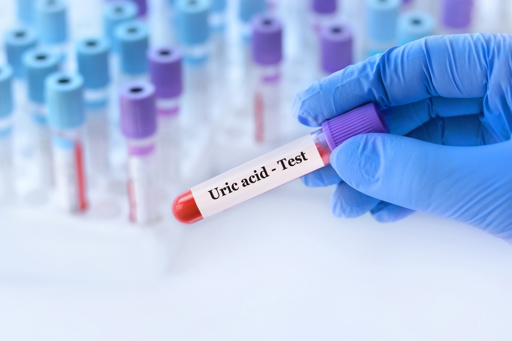 Doctor holding a test blood sample tube with uric acid test on the background of medical test tubes with analyzes