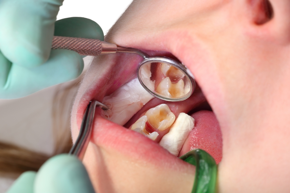 Cavities.Dental caries. Filling with dental composite photopolymer material using rabbders. The concept of dental treatment in a dental clinic