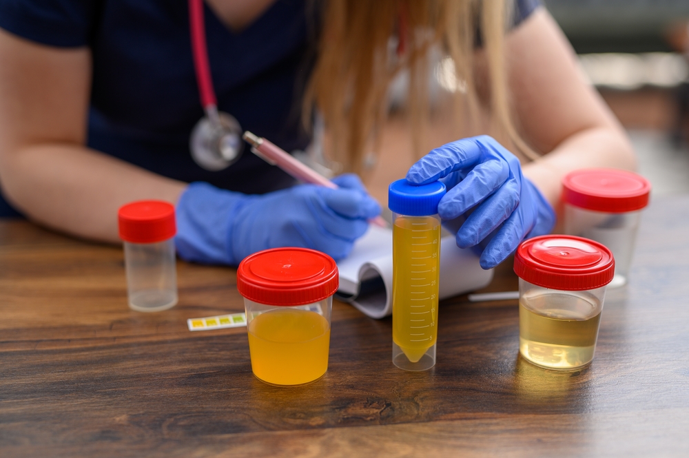 Urine test, describe samples in the laboratory