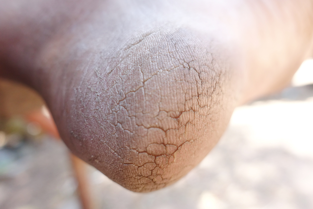 cracked heels