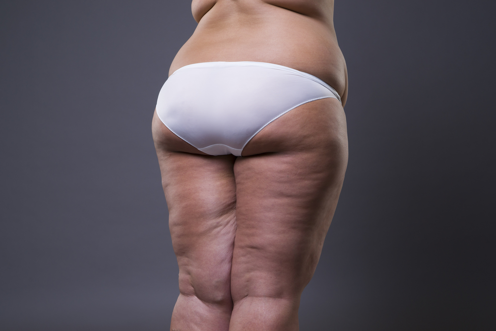 Overweight woman with fat legs and buttocks, obesity female body on gray background