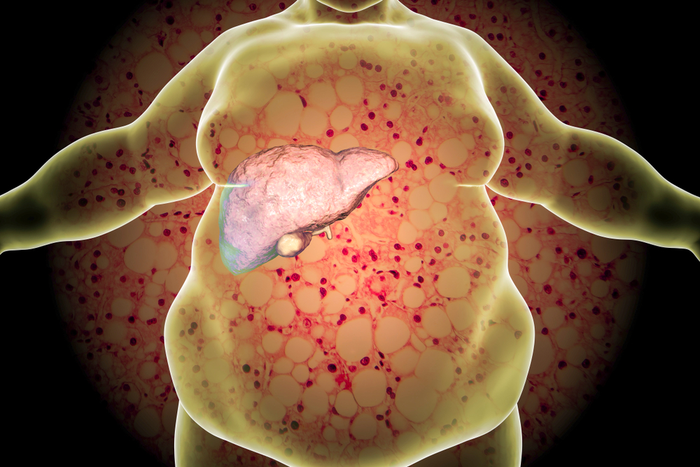 Obese man with fatty liver on background with micrograph of liver steatosis, 3D illustration. Conceptual image for non-alcoholic fatty liver disease