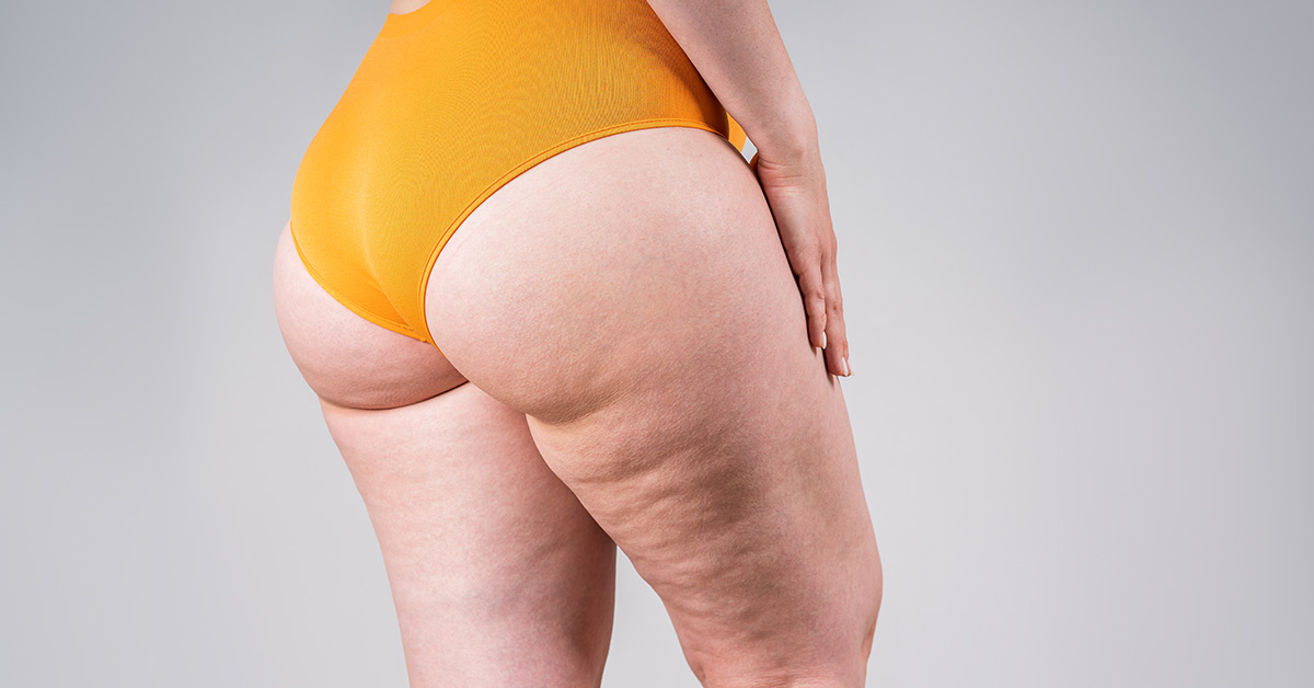 Big Thighs Associated With Lowered Risk of Stroke and Heart Attack