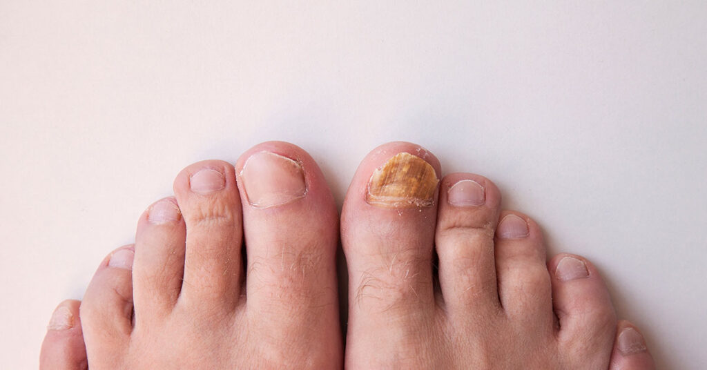 What Causes Thick Toenails and How Can You Treat Them? - Featured image