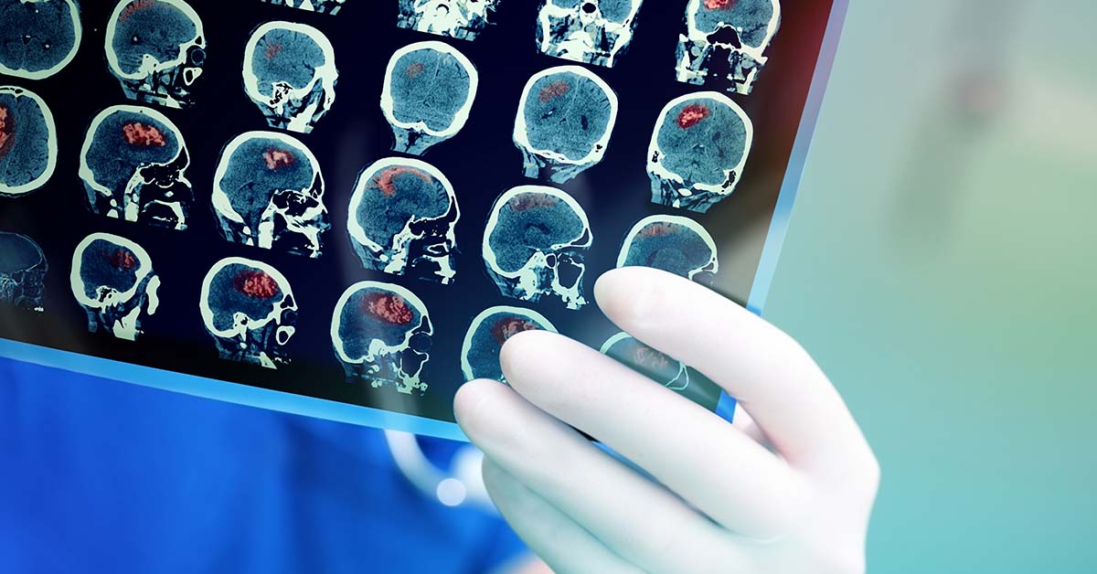 Brain Cancer Specialist Reveals Habits She Adopts To Cut The Risk Of The Disease