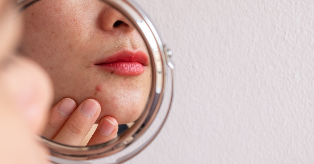 Woman’s pimple under her eye turned out to be skin cancer