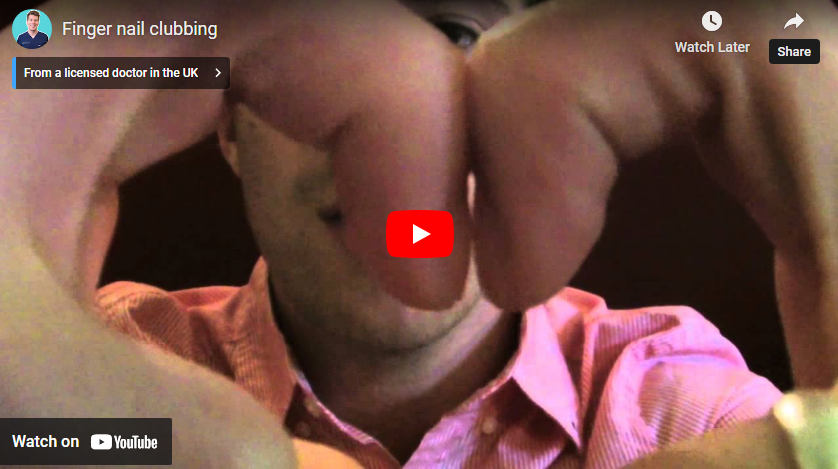 fingernail clubbing youtube video