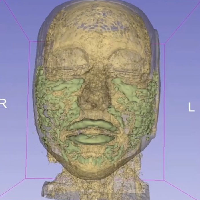 The MRI was extremely telling of the extent of the filler in the face