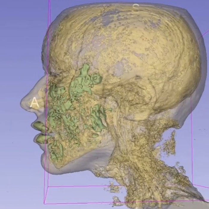 side angle showing the depth of the filler as well 
