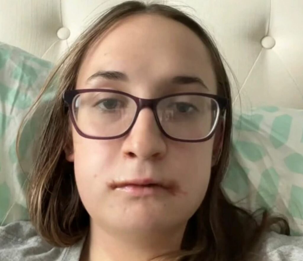 A close-up image of a woman after having jaw surgery, still in hospital.