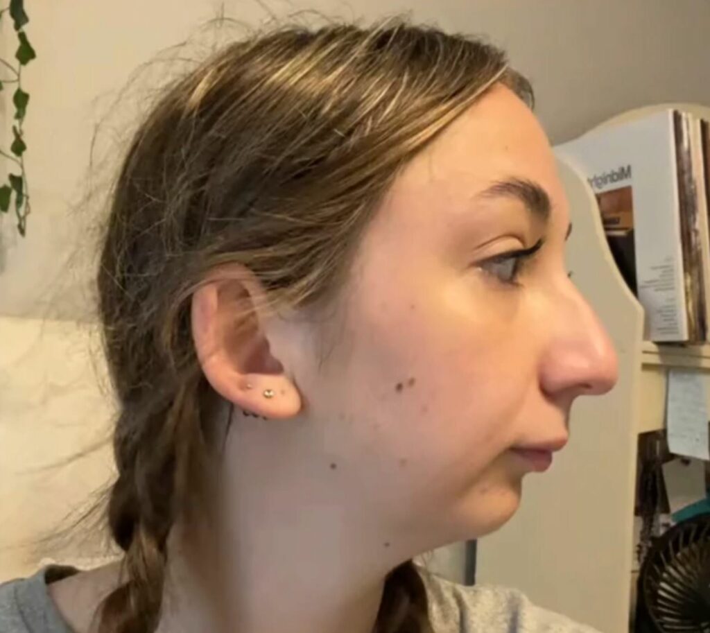 Close up profile of a woman before undergoing jaw surgery.