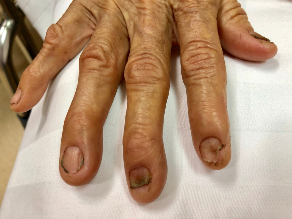 Koilonychia (spoon nail)