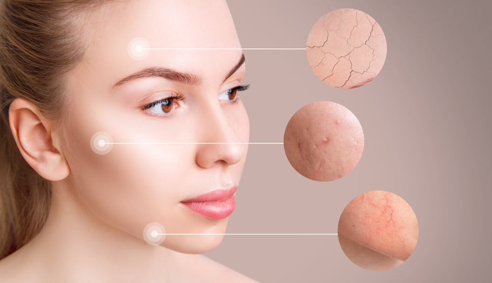 Magnifying circles demonstrate couperose and acne on face skin of young woman. Over beige background.
