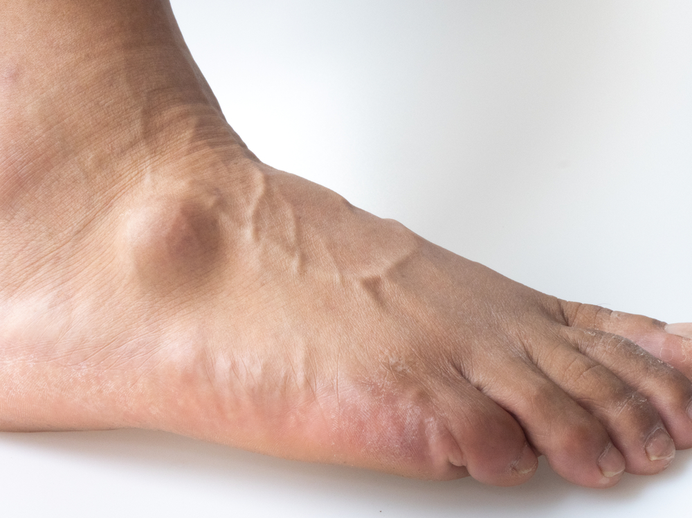 Big ganglion cysts,a sac of jelly like fluid,is on the right foot of man put on the white background.