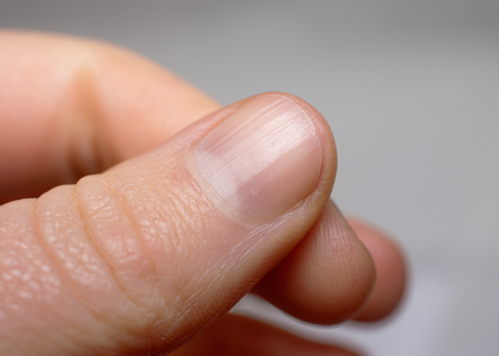 Ridged fingernail of a thumb finger of a caucasian woman with vertical ridges. Very short cut nails.