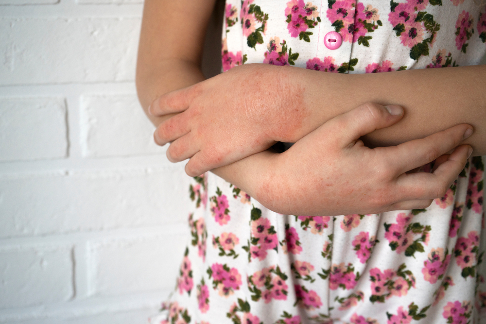 Hands of a little girl with contact dermatitis, Concept with Healthcare And Medicine. Contact dermatitis, skin effects. Health. soft focus