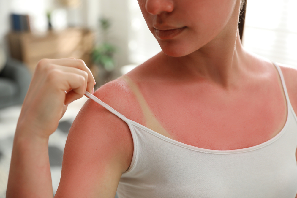Woman with sunburned skin at home, closeup
