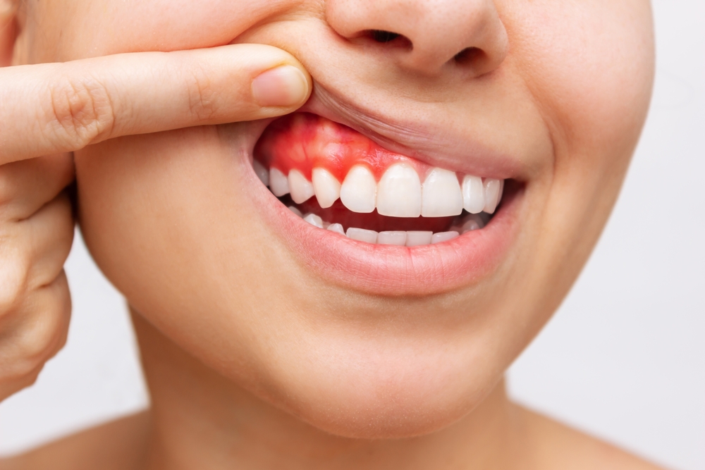 Gum inflammation. Cropped shot of a young woman showing bleeding gums isolated on a white background. Dentistry, dental care
