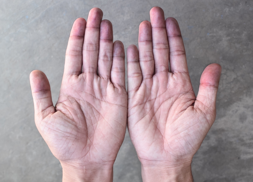 Cyanotic hands or peripheral cyanosis or blue hands at Southeast Asian, Chinese man
