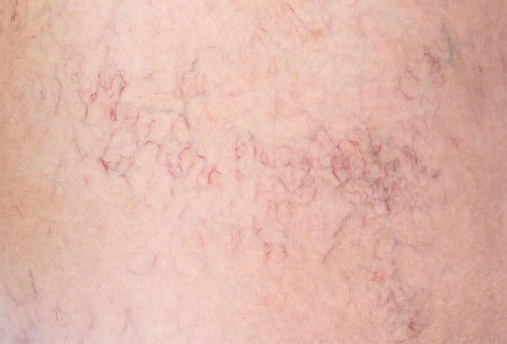 Removal of varicose veins on the legs. Medical inspection and treatment of Telangiectasia. Phlebeurysm.