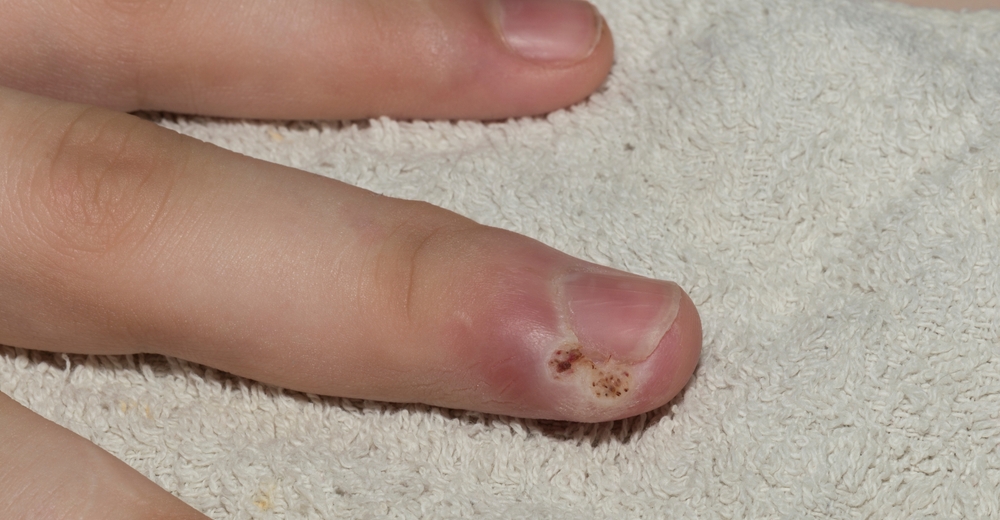 Whitlow or felon is an infection of the tip of the finger.