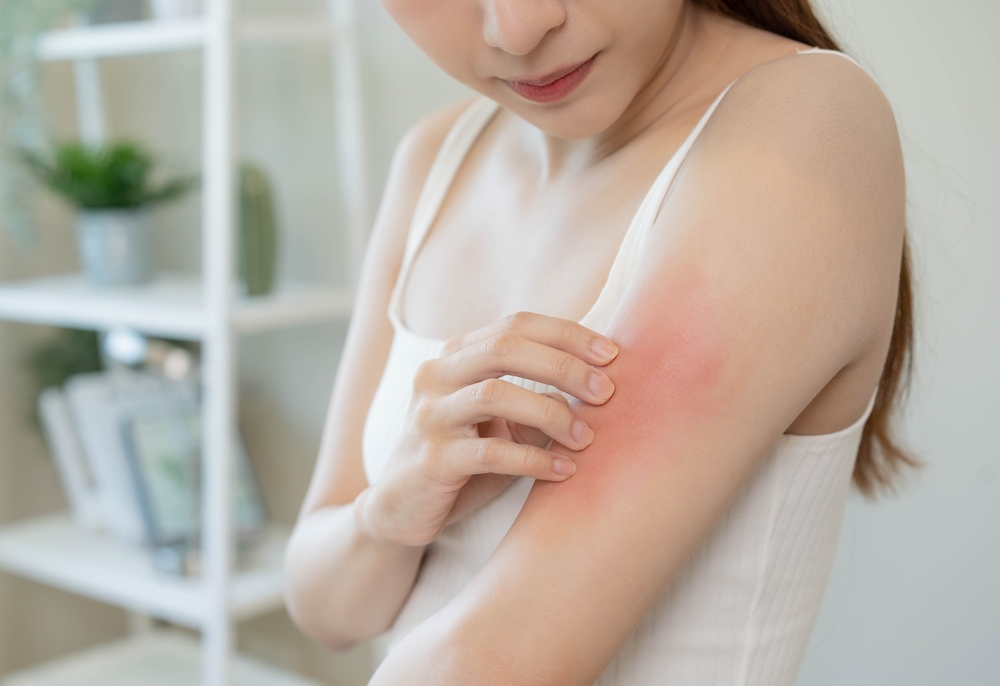 Dermatology, asian young woman, girl allergy, allergic reaction from atopic, insect bites on her arm, hand in scratching itchy, itch red spot or rash of skin. Healthcare, treatment of beauty.