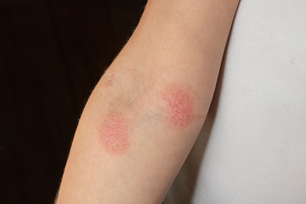 lichen mycosis fungoides on a child's hand close-up
