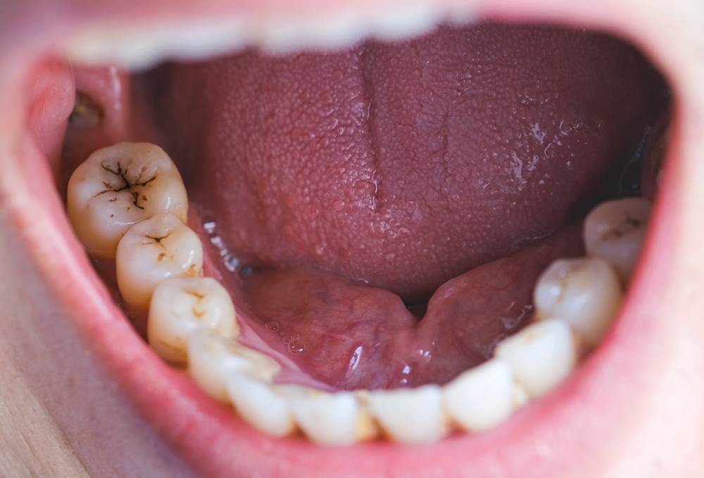 Tooth's a man smoking bad. man smokes a cigarettes have tooth decay and calculus on teeth, So we should be care dental with the hygiene.