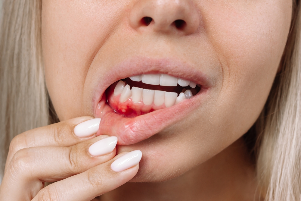 Ulcerative stomatitis on the gums. Gum inflammation. Close up of young blonde woman showing red bleeding gingiva with an ulcer holding her lip. Dentistry, dental care, painful lesion
