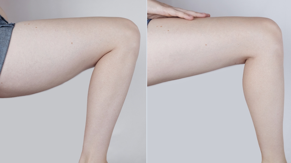 Obesity Cellulite. Sagging flabby skin on woman leg fat. Before and after. Concept losing weight, playing sports, checking result from diet and intense training. Result of losing weight. Liposuction