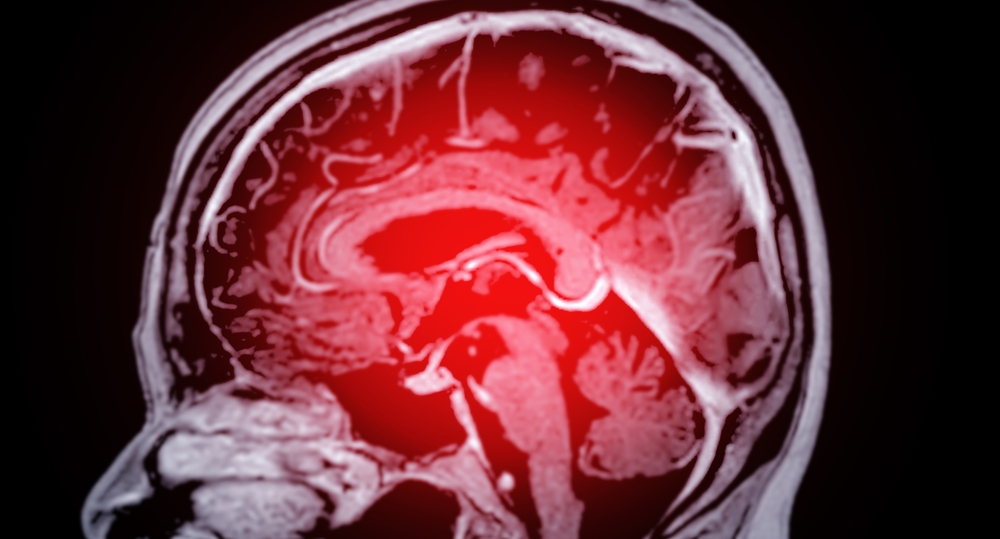 Warning Signs of Stroke You Might Be Missing – Know Every One