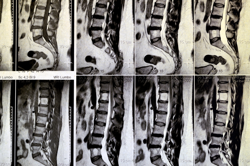 MRI lumbosacral spine without contrast revealed back muscle spasm, Mild L3-L4, L4-L5 disc lesions, Sacral, L5 and T12 vertebral bodies haemangiomata, straightened lumber curvature, selective focus