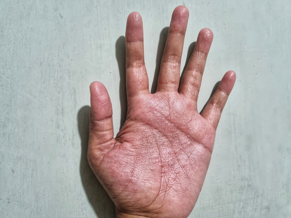 itchy palms and paintfull after gardening