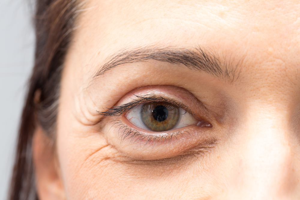 Lady with eye bags
