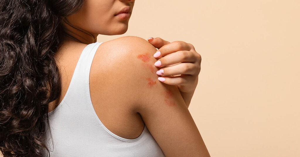 8 Kinds of Food Linked to Eczema Flare-Ups - Featured image