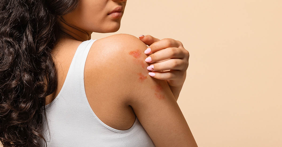 8 Kinds of Food Linked to Eczema Flare-Ups