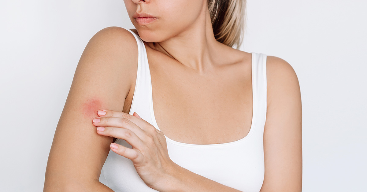 11 Ways to Treat and Stop Mosquito Bites from Itching