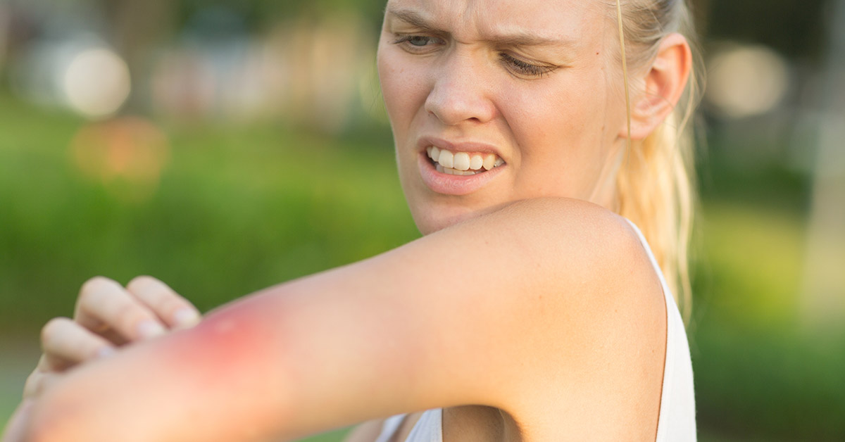 How to Treat a Wasp Sting (And When To Seek Medical Attention)