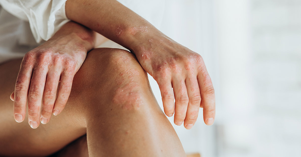 10 Home Remedies for Psoriasis You Can Try Yourself