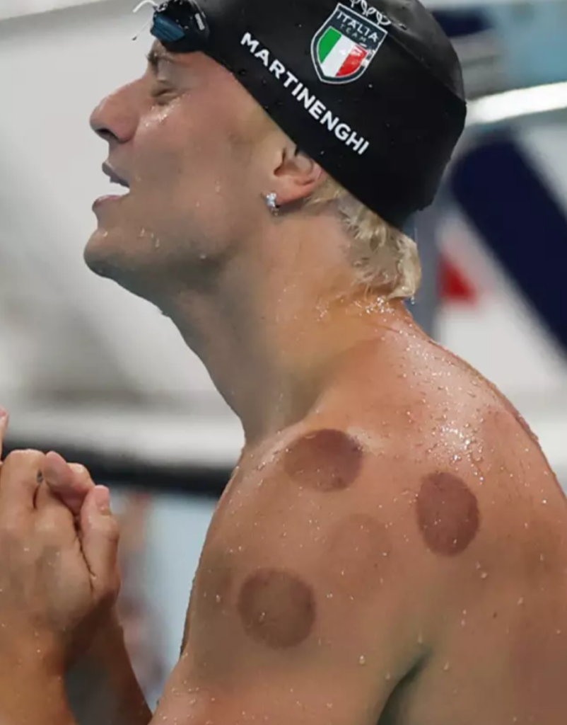 Olympic swimmer after his race with cupping marks.