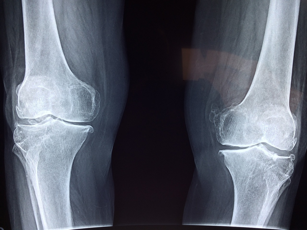 x ray of someones legs