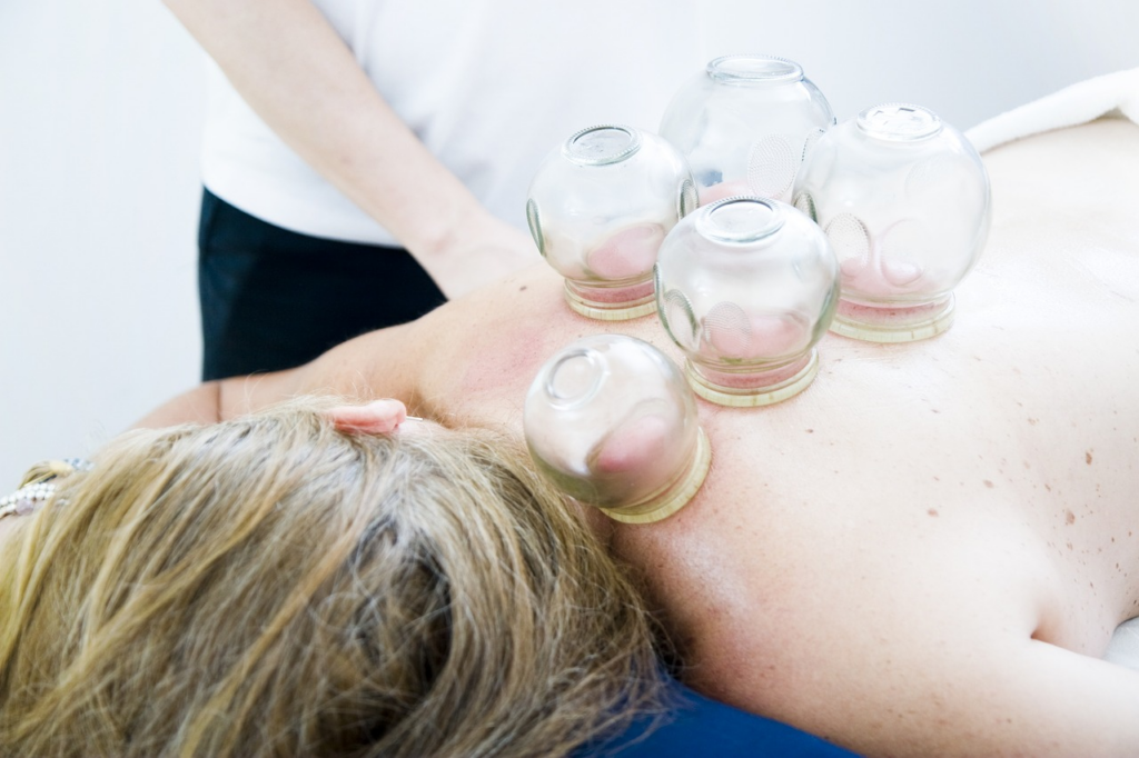 Cupping has a long history of usage for therapy